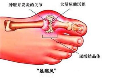 脚趾痛，小心是“第四高”找上你！四个症状，赶紧看看你有没有？